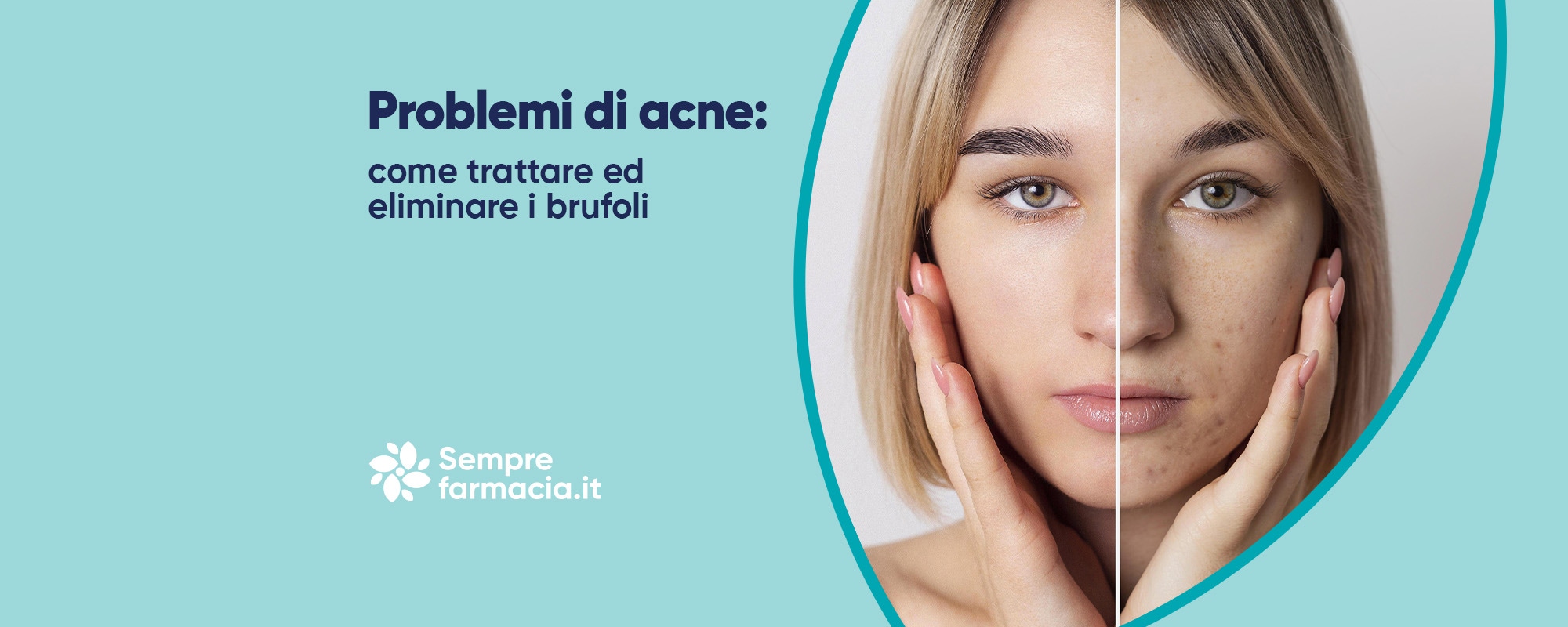 Problemi di acne: come trattare ed eliminare i brufoli